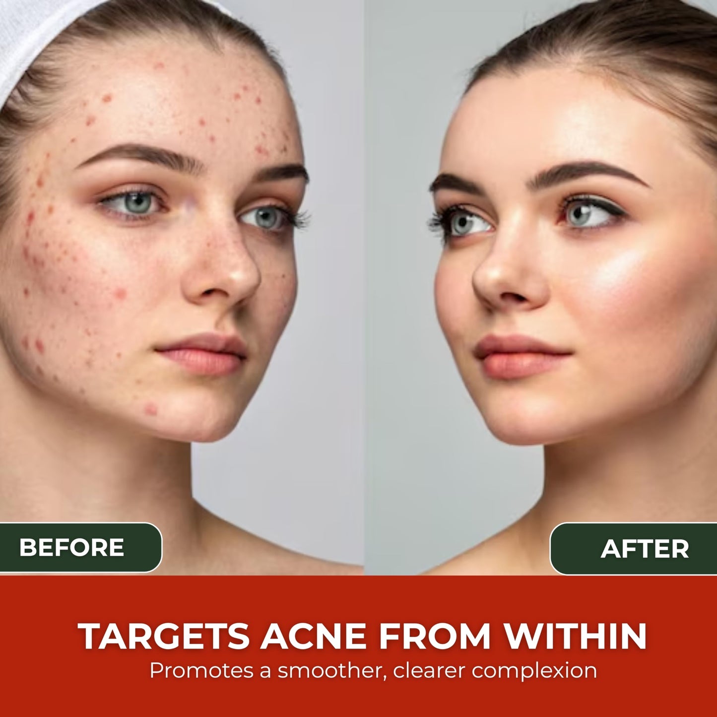 Acne Cleanse Capsules.Powerful Vitex Angus Extract, Niacinamide, Biotin for Teens & Adults. Organic Acne Treatment,Cystic Pimples, Oily Skin to Natural Clear Skin Vitamins Supplement- 60 Count
