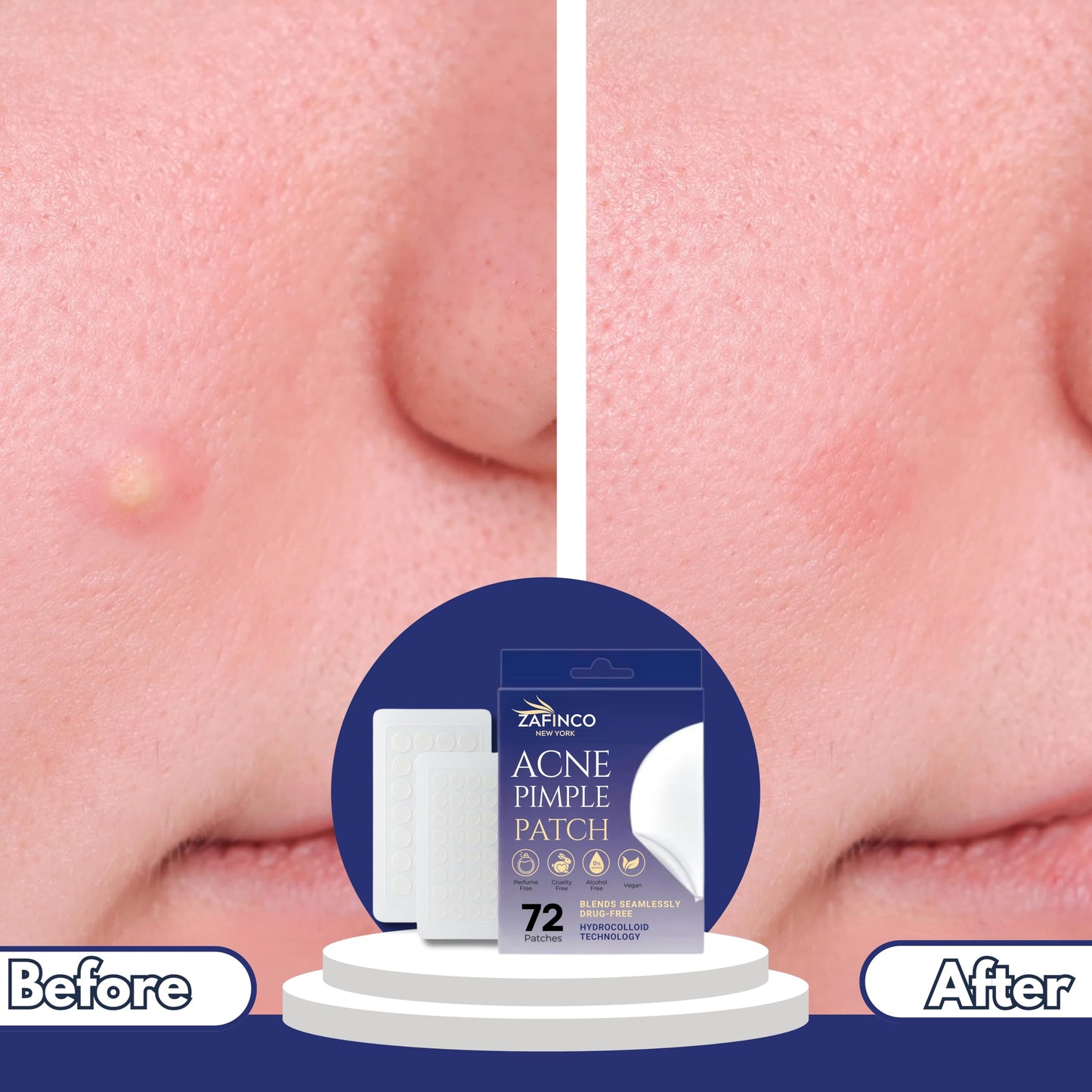 Pimple Patches-Hydrocolloid Acne Patches to fade acne & dark spots - High quality Clear invisible Patches for Skin Care-Covering Zits,Blemishes and Breakouts -Vegan,Cruelty Free- 3 Sizes,72 Count